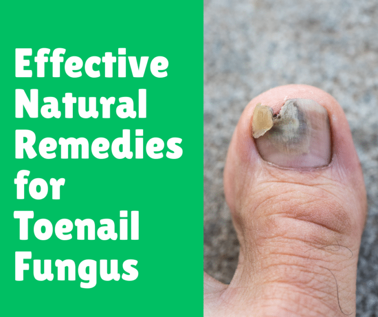 Effective Natural Remedies for Toenail Fungus