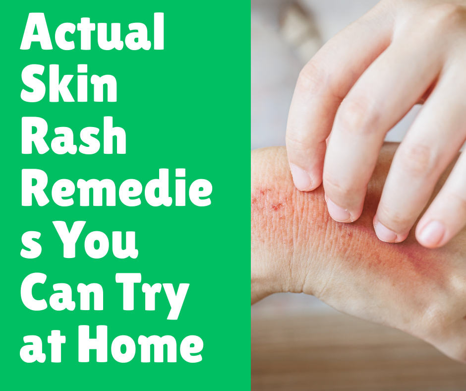 Actual Skin Rash Remedies You Can Try at Home