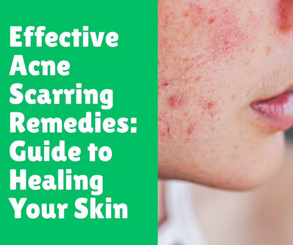 Effective Acne Scarring Remedies_ Guide to Healing Your Skin