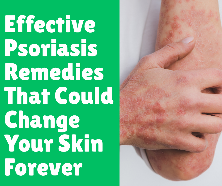 Effective Psoriasis Remedies That Could Change Your Skin Forever