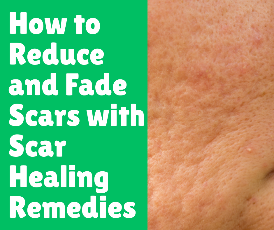How to Reduce and Fade Scars with Scar Healing Remedies