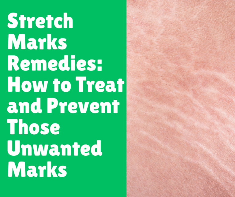 Stretch Marks Remedies_ How to Treat and Prevent Those Unwanted Marks