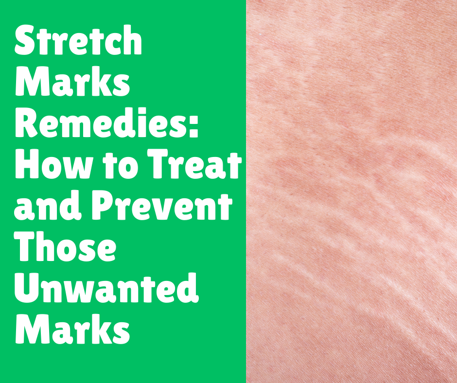 Stretch Marks Remedies_ How to Treat and Prevent Those Unwanted Marks